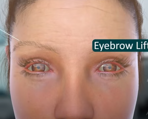 LivDerm medical animation