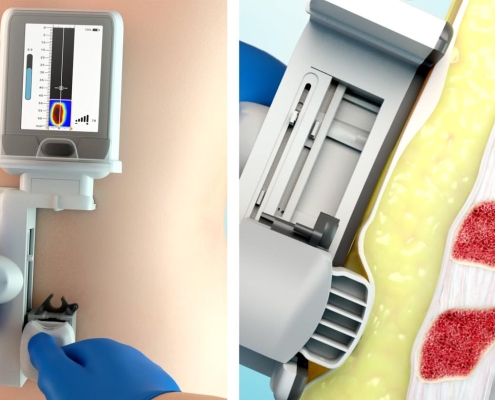 IntuiTap Medical